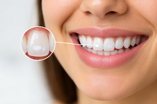 White Spots on Teeth: Why They Appear and How to Treat Them